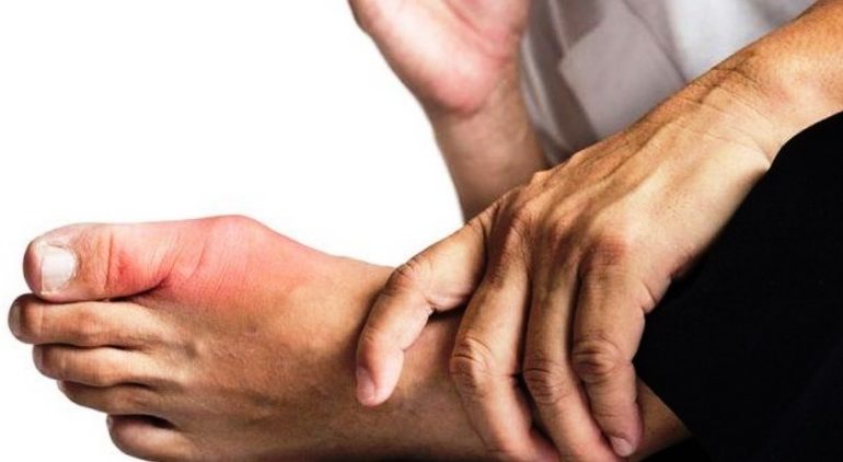 Kenali Gejala Asam Urat (Gout), Penyebab dan Faktor Risiko